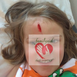 große Platzwunde an der Stirn muss genäht werden